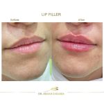 lip filler before and after