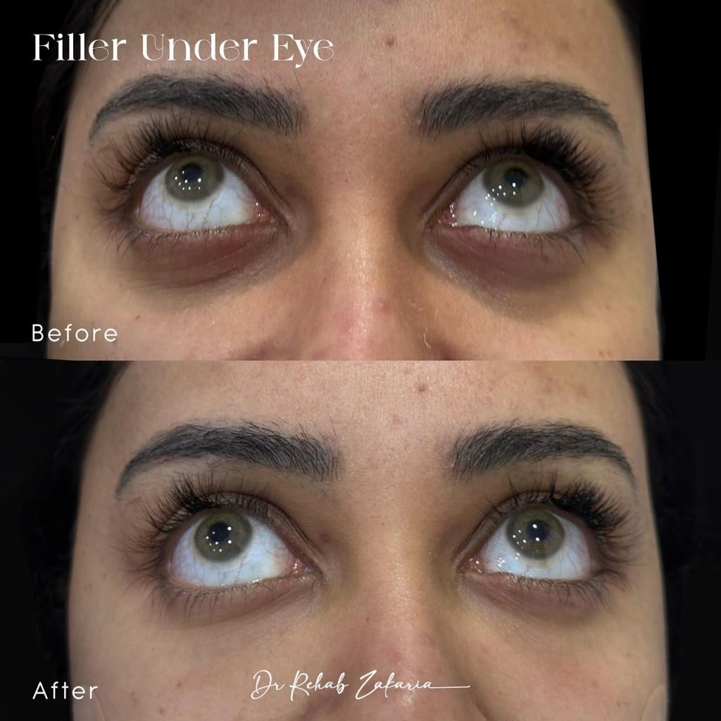 فيلر تحت العين 