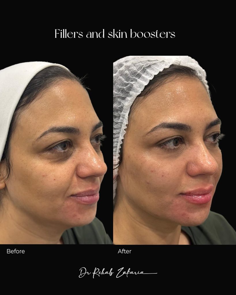 السكين بوستر: علاج تعزيز البشرة مع الدكتورة رحاب زكريا سكين بوستر