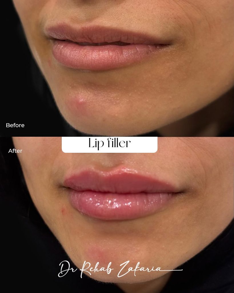 lip filler 