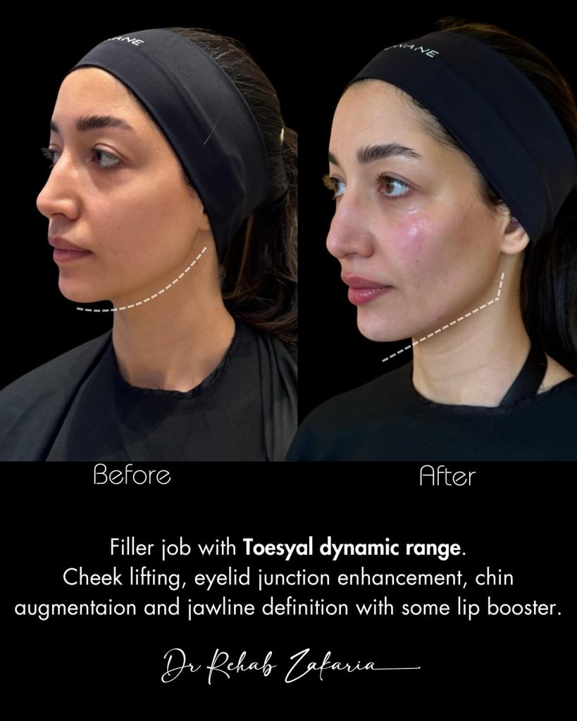 فيلر الوجه الكامل