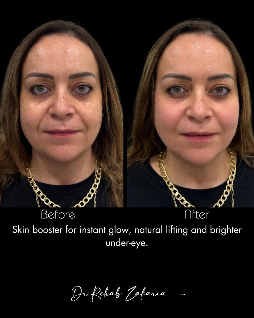 سكين بوستر: الدليل الشامل لتجديد البشرة وتصغير عمر الجلد بفعالية مذهلة سكين بوستر