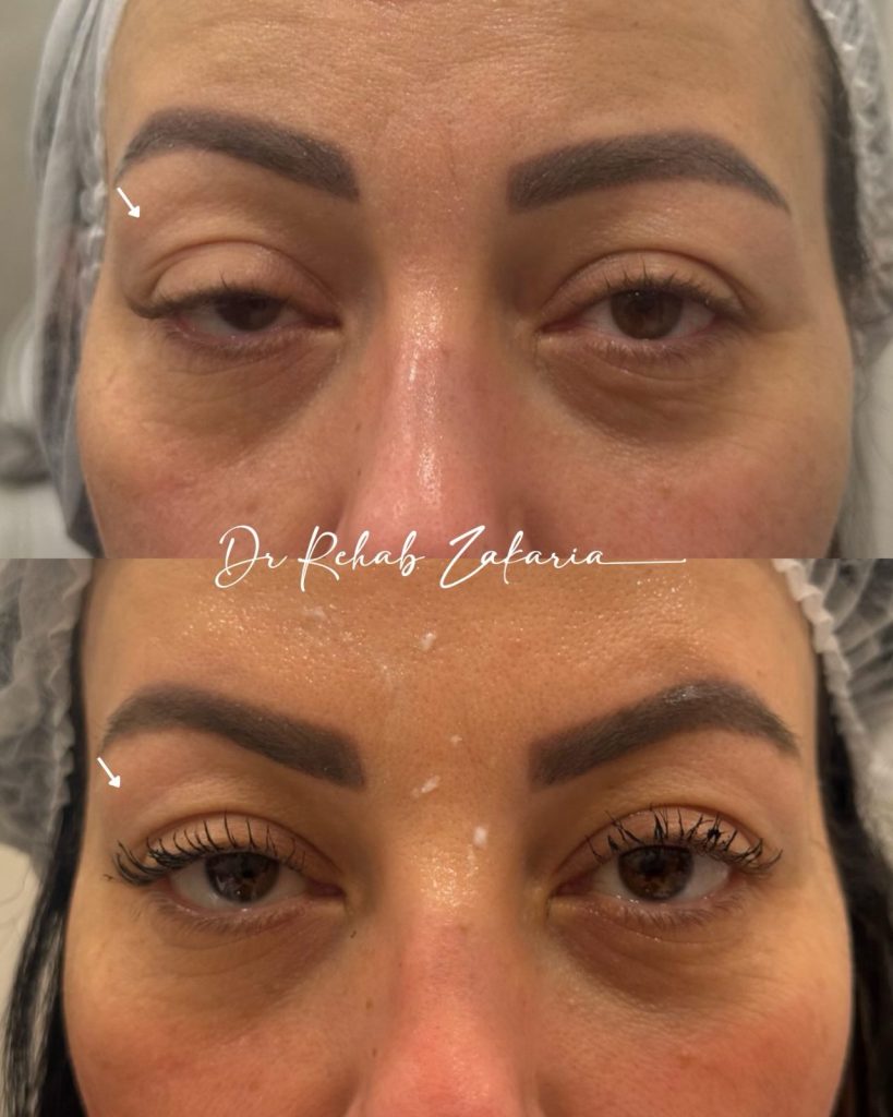 استخدام حقن البوتوكس لرفع الجفون و الحاجب بشكل طبيعي و صحي حقن البوتوكس لرفع الجفون