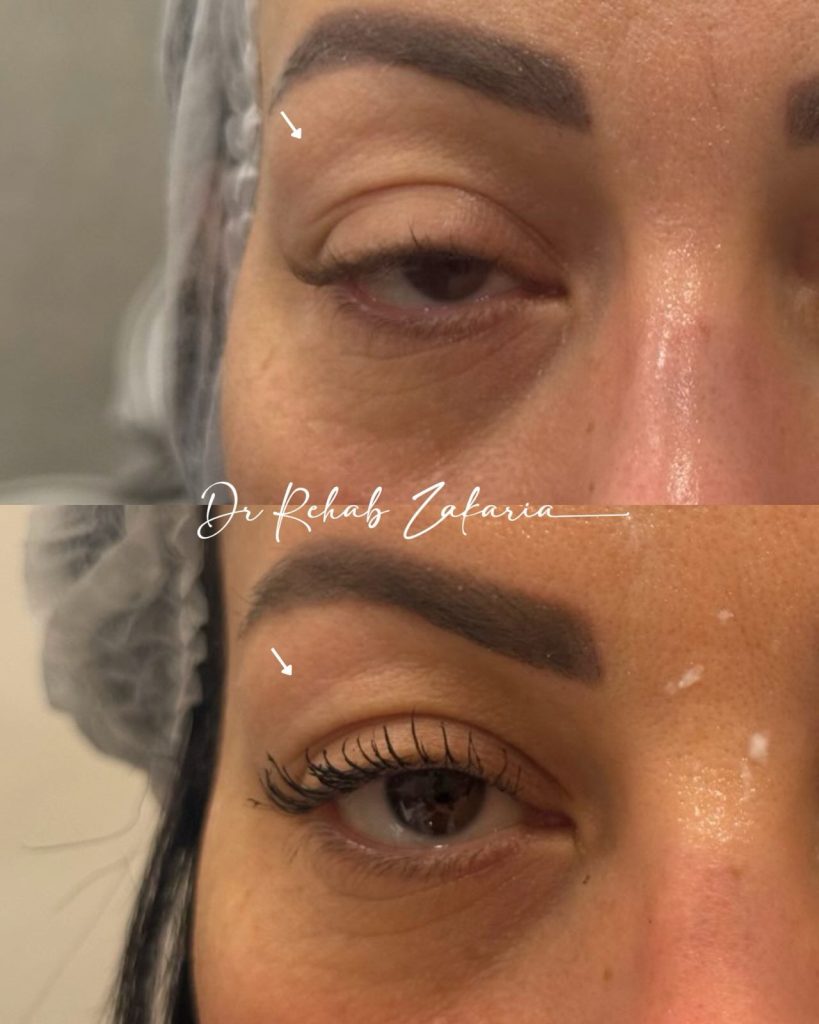 استخدام حقن البوتوكس لرفع الجفون و الحاجب بشكل طبيعي و صحي