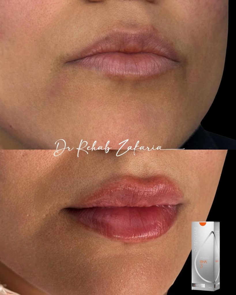 تعليمات بعد فيلر الشفايف