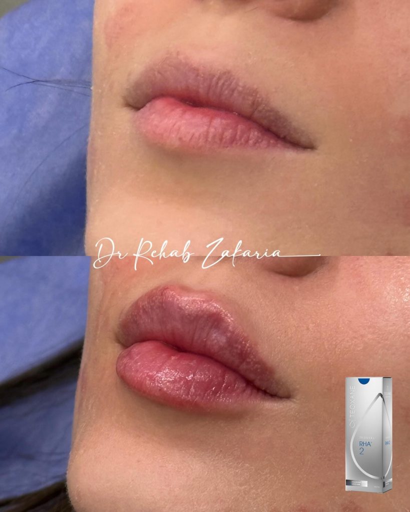 تعليمات بعد فيلر الشفايف فيلر الشفايف