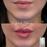 lip filler after and before